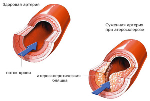 Уплотнение в сосудах